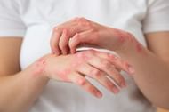 There are many food items that can decrease the skin issue. (image by freepik on freepik)
